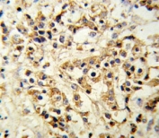 FGFR1 antibody IHC analysis in formalin fixed and paraffin embedded human breast carcinoma.