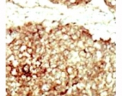 IHC analysis of FFPE human hepatocarcinoma tissue stained with the FGFR2 antibody