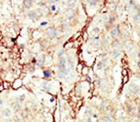 IHC analysis of FFPE human breast carcinoma tissue stained with the FGFR3 antibody~