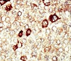 IHC analysis of FFPE human hepatocarcinoma tissue stained with the FGFR4 antibody