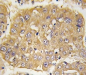 IHC analysis of FFPE human hepatocarcinoma tissue stained with IGFBP3 antibody