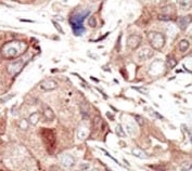 IHC analysis of FFPE human breast carcinoma tissue stained with the VEGFR2 antibody