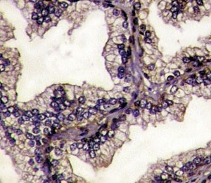 IHC analysis of FFPE prostate carcinoma tissue stained with Lactoferrin antibody. ~