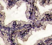 IHC analysis of FFPE prostate carcinoma tissue stained with Lactoferrin antibody.