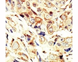 IHC analysis of FFPE human breast carcinoma tissue stained with the IGF1R antibody~
