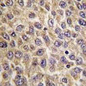 IHC analysis of FFPE human hepatocarcinoma tissue stained with ILK antibody