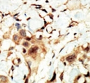 IHC analysis of FFPE human breast carcinoma tissue stained with the Insulin Receptor antibody