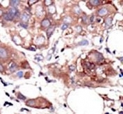IHC analysis of FFPE human breast carcinoma tissue stained with the MUSK antibody