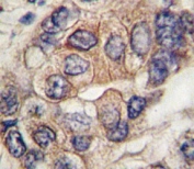 IHC analysis of FFPE human hepatocarcinoma tissue stained with PDGFR antibody