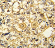 IHC analysis of FFPE human breast carcinoma stained with PDGFR beta antibody