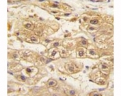 IHC analysis of FFPE human hepatocarcinoma tissue stained with PDGFRB antibody