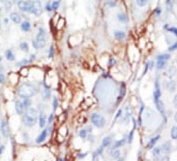 IHC analysis of FFPE human breast carcinoma tissue stained with the PDGFRL antibody