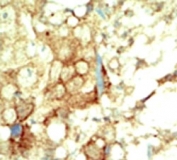 IHC analysis of FFPE human breast carcinoma tissue stained with the RET antibody