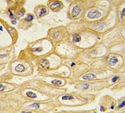 IHC testing of FFPE human lung carcinoma with ROR1 antibody.