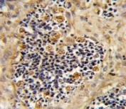 IHC analysis of FFPE human kidney carcionma stained with ROR2 antibody