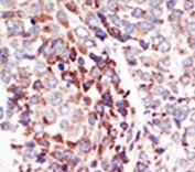 IHC analysis of FFPE human hepatocarcinoma tissue stained with the TIE2 antibody