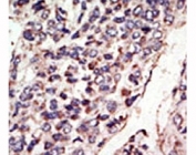IHC analysis of FFPE human hepatocarcinoma tissue stained with the TRKC antibody