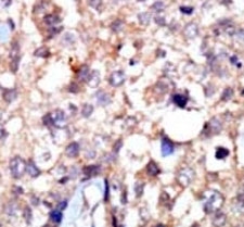 IHC analysis of FFPE human breast carcinoma tissue stained with the ABL1 antibody