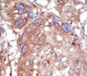 IHC analysis of FFPE human hepatocarcinoma tissue stained with the ACK1 antibody
