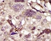 IHC analysis of FFPE human breast carcinoma tissue stained with the BTK antibody