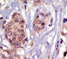 IHC analysis of FFPE human breast carcinoma tissue stained with the FYN antibody