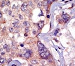 IHC analysis of FFPE human breast carcinoma tissue stained with the LCK antibody