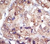 IHC analysis of FFPE human hepatocarcinoma tissue stained with the LYN antibody