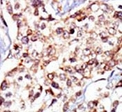 IHC analysis of FFPE human breast carcinoma tissue stained with the c-Src antibody