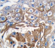 IHC analysis of FFPE human lung carcinoma tissue stained with NRAS antibody