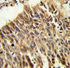 HIF1A antibody IHC analysis in formalin fixed and paraffin embedded lung carcinoma.