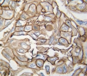 IHC analysis of FFPE human lung carcinoma tissue stained with HRAS antibody