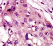 IHC analysis of FFPE human hepatocarcinoma tissue stained with the IRAK2 antibody