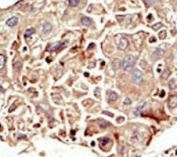 IHC analysis of FFPE human hepatocarcinoma tissue stained with the ALK2 antibody