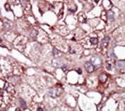 IHC analysis of FFPE human hepatocarcinoma tissue stained with the ALK1 antibody