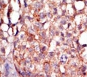 IHC analysis of FFPE human breast carcinoma tissue stained with the RIPK4 antibody
