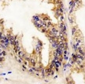 IHC analysis of FFPE human prostate carcinoma stained with B-RAF antibody