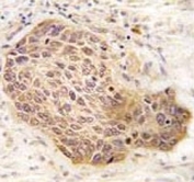 IHC analysis of FFPE human lung carcinoma tissue stained with RIPK2 antibody