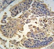 IHC analysis of FFPE human lung carcinoma tissue stained with RIPK3 antibody