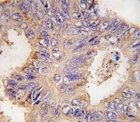 IHC analysis of FFPE human colon carcinoma tissue stained with TRAF2 antibody~