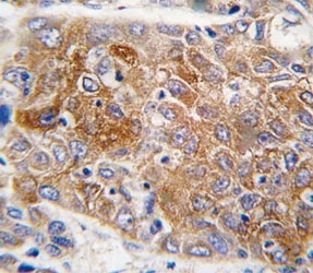 IHC analysis of FFPE human hepatocarcinoma tissue stained with ALDH1L1 antibody~