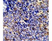 IHC analysis of FFPE human lymphoma stained with MERTK antibody
