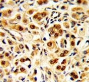 IHC analysis of FFPE human prostate carcinoma with GAPDH antibody