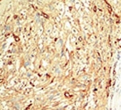 IHC analysis of FFPE human breast carcinoma tissue stained with the MST1 antibody