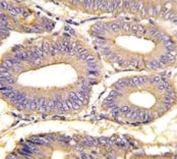 IHC analysis of FFPE human colon carcinoma tissue stained with PAK1 antibody