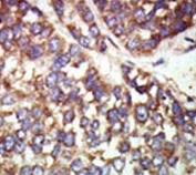 IHC analysis of FFPE human hepatocarcinoma tissue stained with the PAK2 antibody