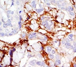 IHC analysis of FFPE human breast carcinoma tissue stained with the PAK3 antibody~