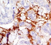 IHC analysis of FFPE human breast carcinoma tissue stained with the PAK3 antibody