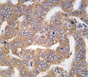 IHC analysis of FFPE human prostate carcinoma tissue stained with PAK4 antibody~