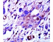 IHC analysis of FFPE human breast carcinoma tissue stained with the PLK1 antibody
