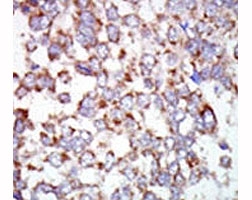 IHC analysis of FFPE human hepatocarcinoma tissue stained with the TAK1 antibody~